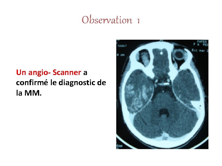 Observation 1 Un angio- Scanner a confirmé le diagnostic de la MM. 