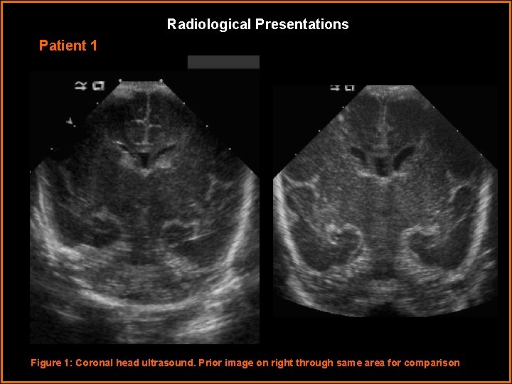 Radiological Presentations Patient 1 Figure 1: Coronal head ultrasound. Prior image on right through
