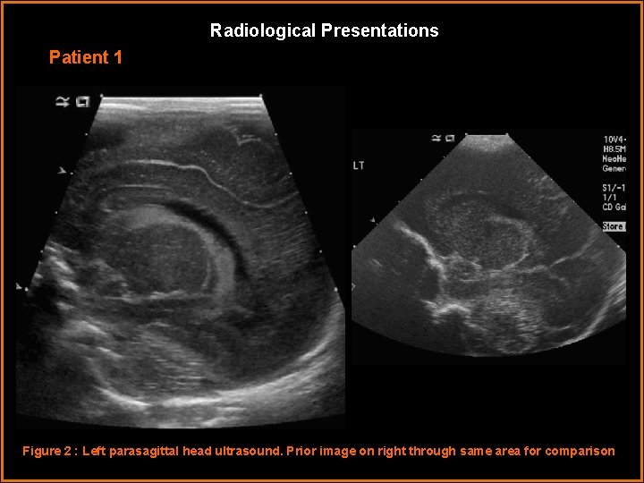 Radiological Presentations Patient 1 Figure 2 : Left parasagittal head ultrasound. Prior image on