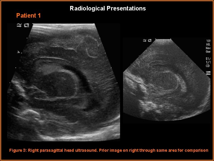 Radiological Presentations Patient 1 Figure 3: Right parasagittal head ultrasound. Prior image on right