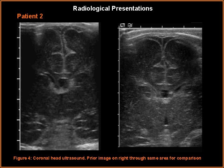 Radiological Presentations Patient 2 Figure 4: Coronal head ultrasound. Prior image on right through