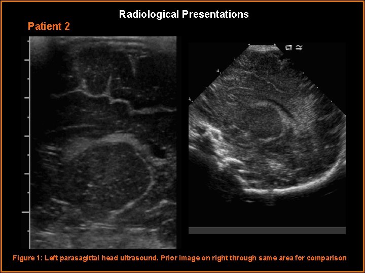 Radiological Presentations Patient 2 Figure 1: Left parasagittal head ultrasound. Prior image on right