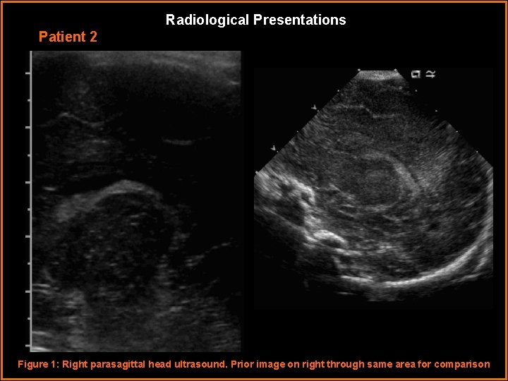 Radiological Presentations Patient 2 Figure 1: Right parasagittal head ultrasound. Prior image on right