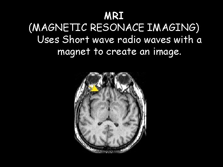 MRI (MAGNETIC RESONACE IMAGING) Uses Short wave radio waves with a magnet to create