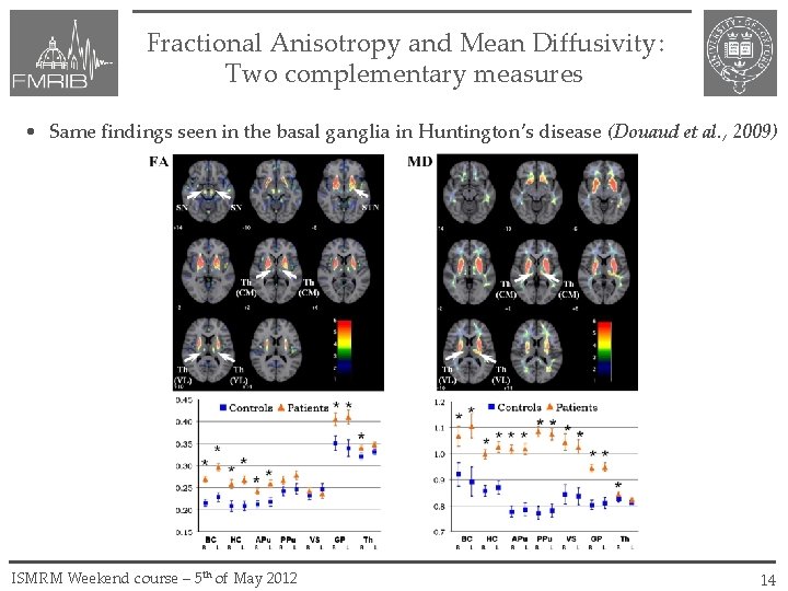 Fractional Anisotropy and Mean Diffusivity: Two complementary measures • Same findings seen in the