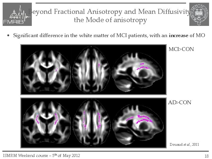 Beyond Fractional Anisotropy and Mean Diffusivity: the Mode of anisotropy • Significant difference in