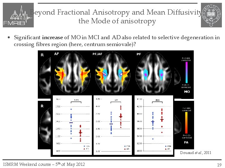 Beyond Fractional Anisotropy and Mean Diffusivity: the Mode of anisotropy • Significant increase of