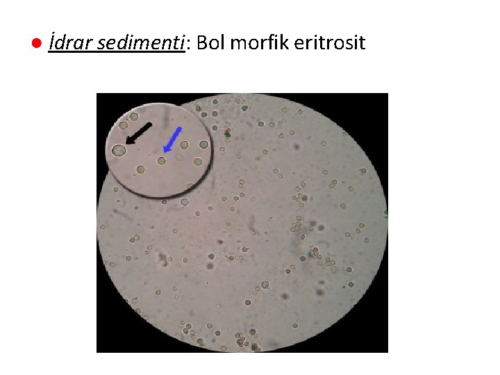 ● İdrar sedimenti: Bol morfik eritrosit 