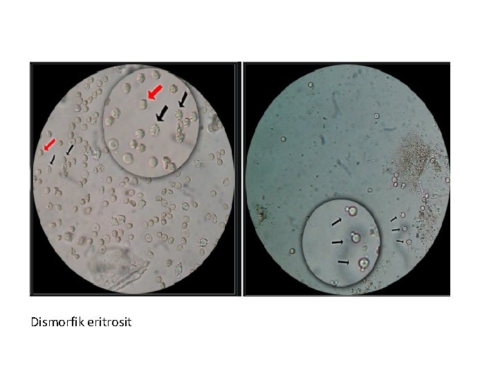 Dismorfik eritrosit 
