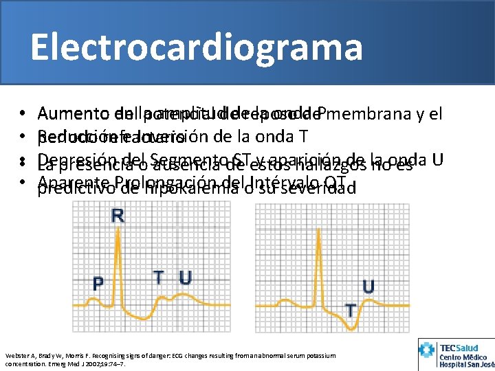 Electrocardiograma • • • Aumento en la amplitud de la onda P Aumento del