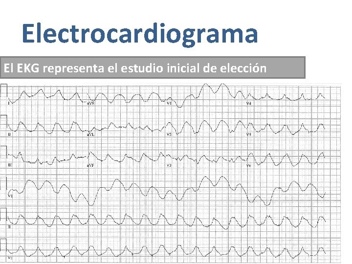 Electrocardiograma El EKG representa el estudio inicial de elección 1. - Ondas T picudas