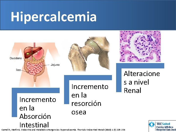 Hipercalcemia Incremento en la Absorción Intestinal Incremento en la resorción osea Alteracione s a