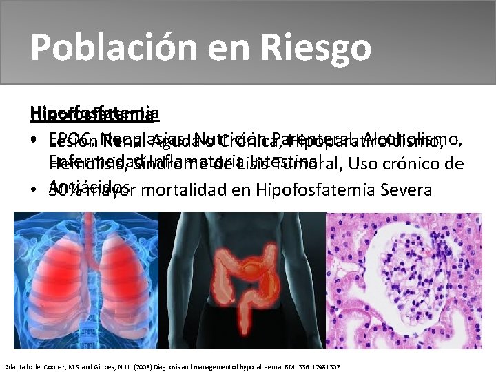 Población en Riesgo Hiperfosfatemia Hipofosfatemia • EPOC, Neoplasias, Nutrición Parenteral, Alcoholismo, Lesión Renal Aguda