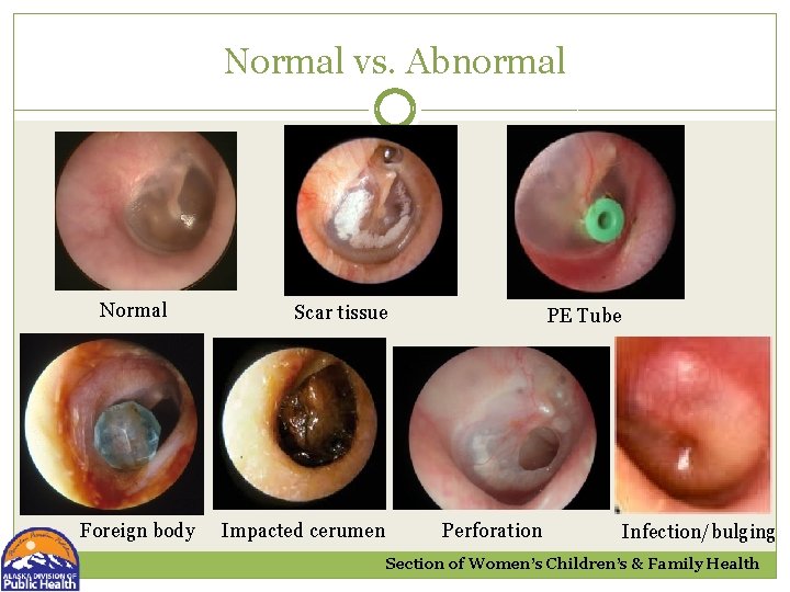 Normal vs. Abnormal Normal Foreign body Scar tissue Impacted cerumen PE Tube Perforation Infection/bulging