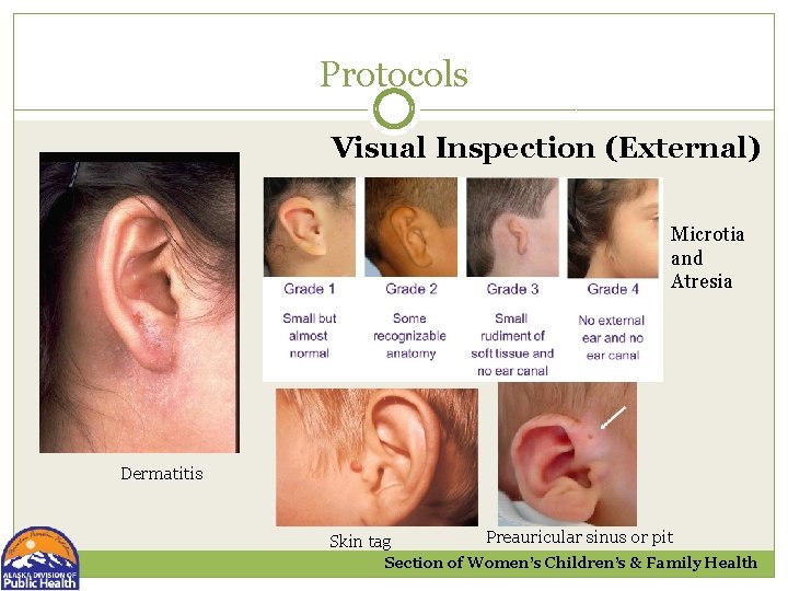 Protocols Visual Inspection (External) Microtia and Atresia Dermatitis Skin tag Preauricular sinus or pit