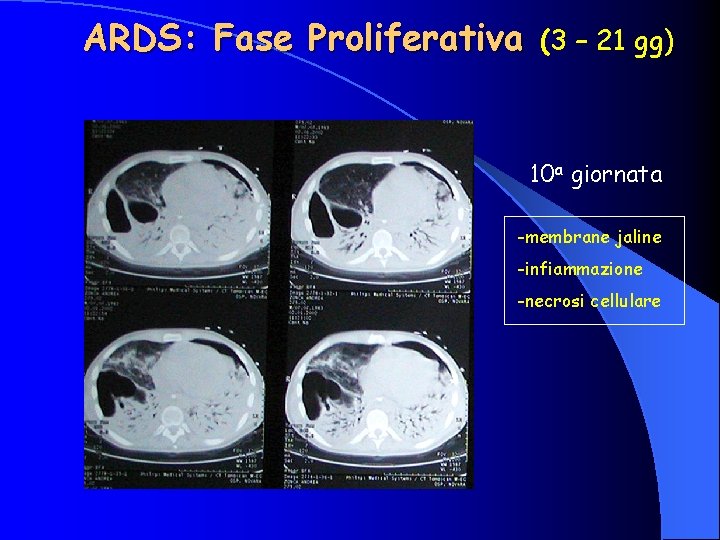 ARDS: Fase Proliferativa (3 – 21 gg) 10 a giornata -membrane jaline -infiammazione -necrosi