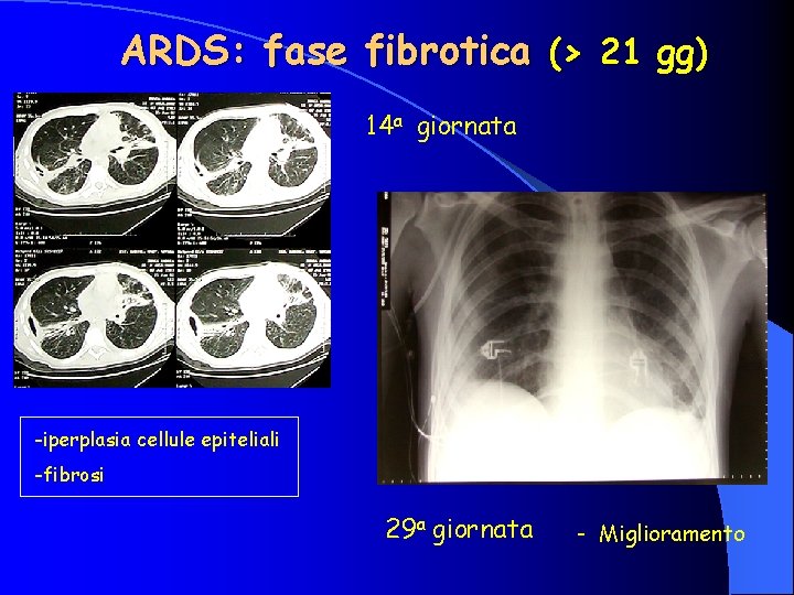 ARDS: fase fibrotica (> 21 gg) 14 a giornata -iperplasia cellule epiteliali -fibrosi 29