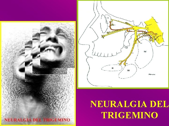 NEURALGIA DEL TRIGEMINO 