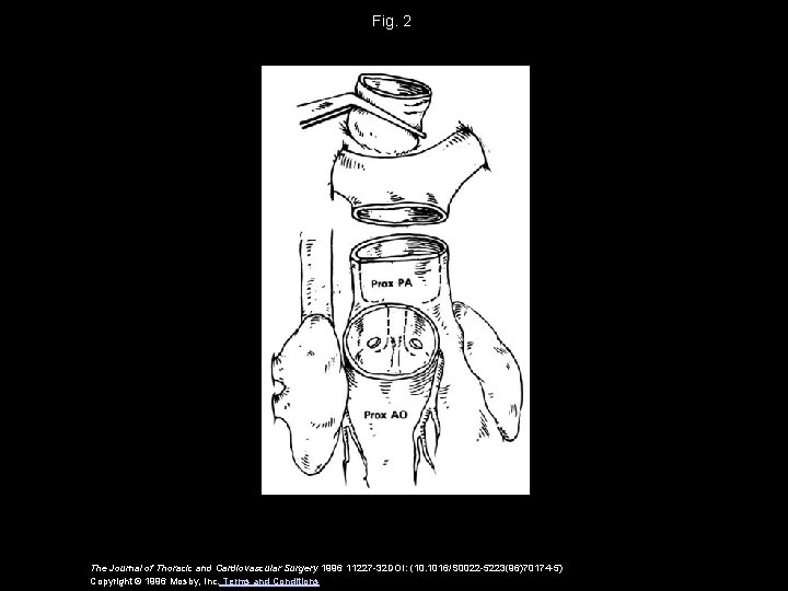 Fig. 2 The Journal of Thoracic and Cardiovascular Surgery 1996 11227 -32 DOI: (10.