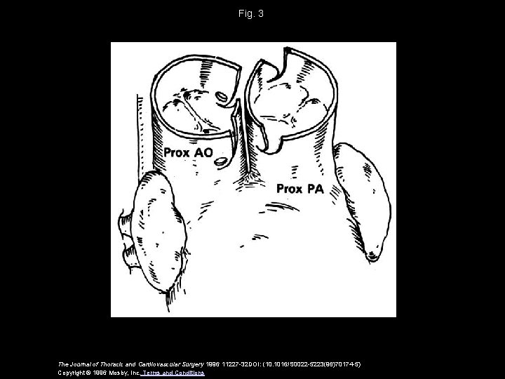 Fig. 3 The Journal of Thoracic and Cardiovascular Surgery 1996 11227 -32 DOI: (10.