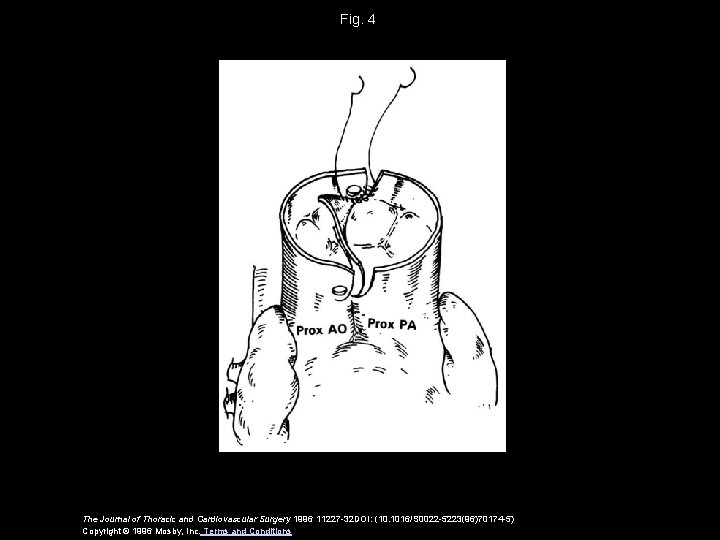 Fig. 4 The Journal of Thoracic and Cardiovascular Surgery 1996 11227 -32 DOI: (10.