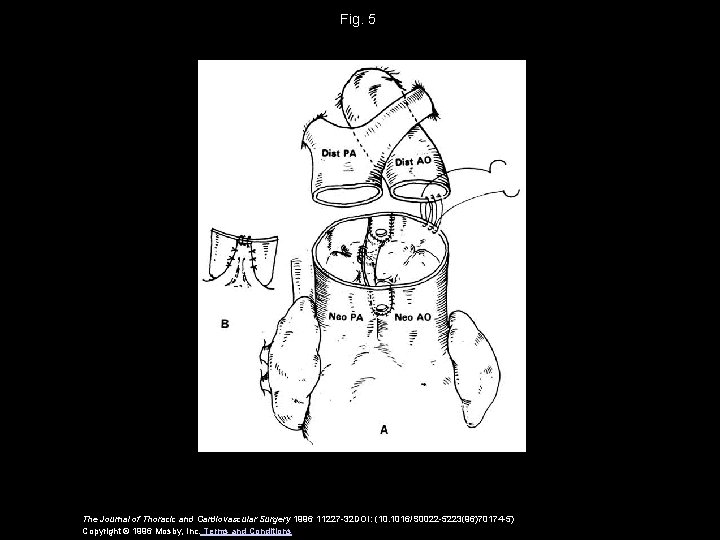 Fig. 5 The Journal of Thoracic and Cardiovascular Surgery 1996 11227 -32 DOI: (10.