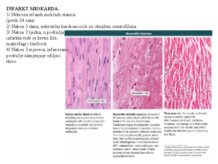 INFARKT MIOKARDA. 1/ Nekroza srčanih mišićnih stanica (prvih 24 sata) 2/ Nakon 3 dana,