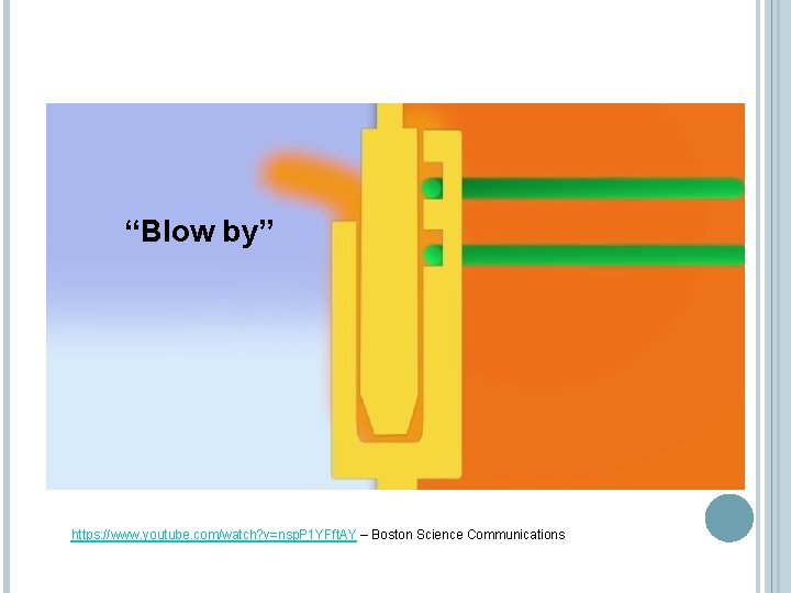 “Blow by” https: //www. youtube. com/watch? v=nsp. P 1 YFft. AY – Boston Science “Blow by” https: //www. youtube. com/watch? v=nsp. P 1 YFft. AY – Boston Science