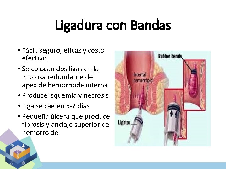 Ligadura con Bandas • Fácil, seguro, eficaz y costo efectivo • Se colocan dos