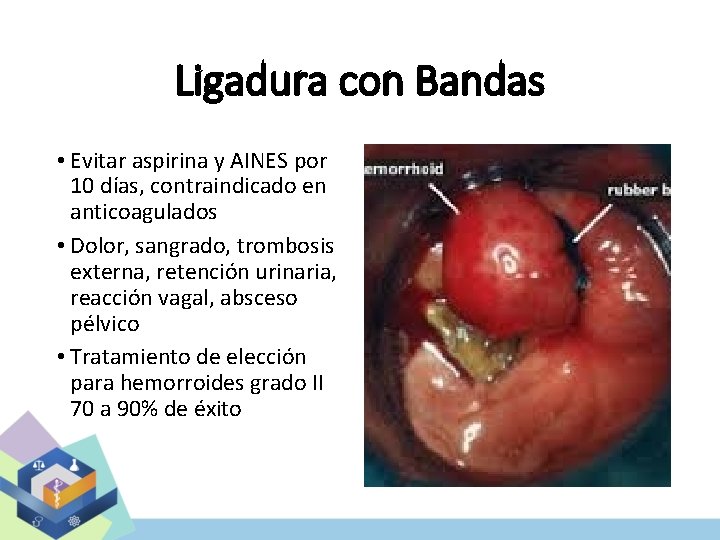 Ligadura con Bandas • Evitar aspirina y AINES por 10 días, contraindicado en anticoagulados