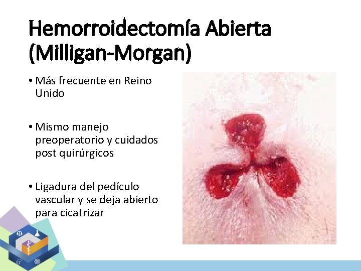 Hemorroidectomía Abierta (Milligan-Morgan) • Más frecuente en Reino Unido • Mismo manejo preoperatorio y