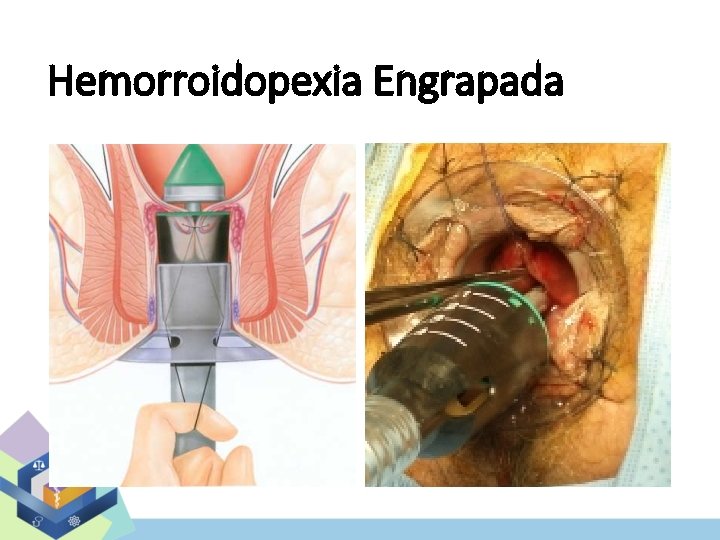 Hemorroidopexia Engrapada 