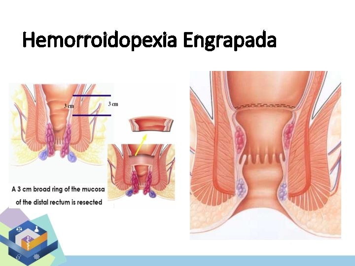 Hemorroidopexia Engrapada 