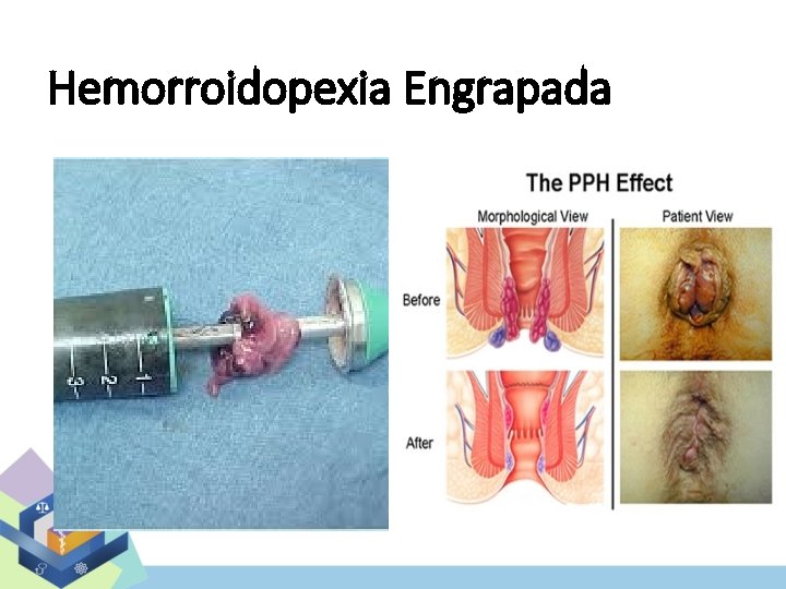 Hemorroidopexia Engrapada 