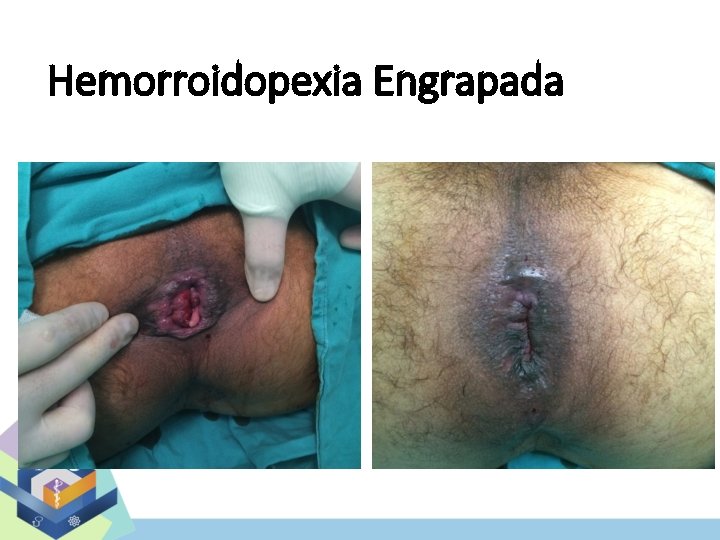 Hemorroidopexia Engrapada 