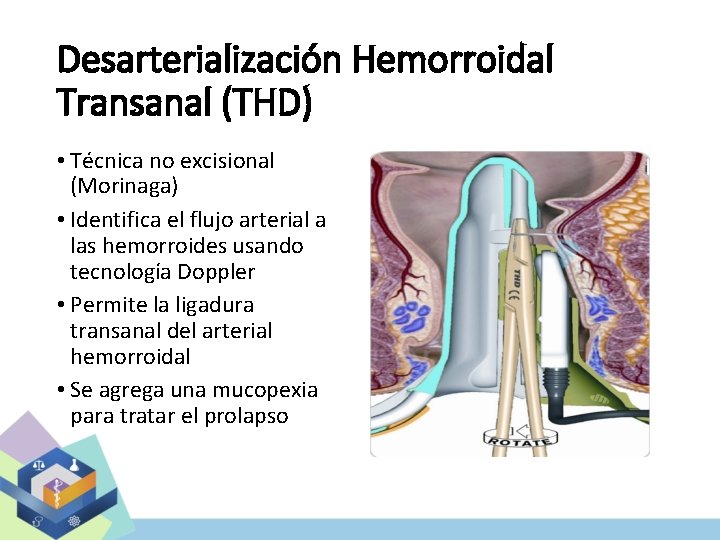 Desarterialización Hemorroidal Transanal (THD) • Técnica no excisional (Morinaga) • Identifica el flujo arterial