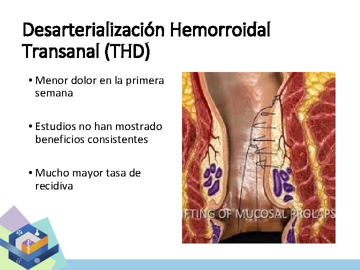 Desarterialización Hemorroidal Transanal (THD) • Menor dolor en la primera semana • Estudios no