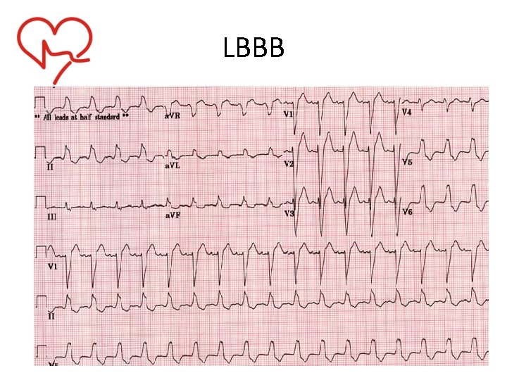 LBBB 