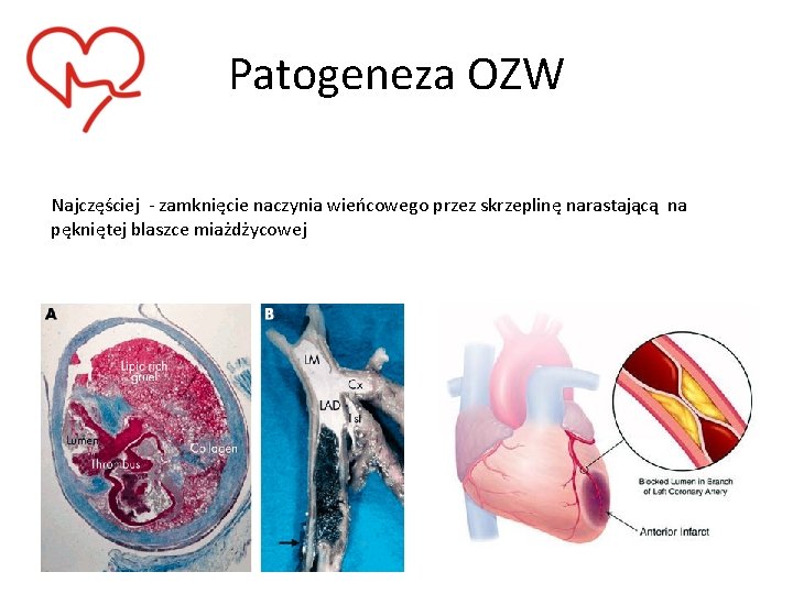 Patogeneza OZW Najczęściej - zamknięcie naczynia wieńcowego przez skrzeplinę narastającą na pękniętej blaszce miażdżycowej