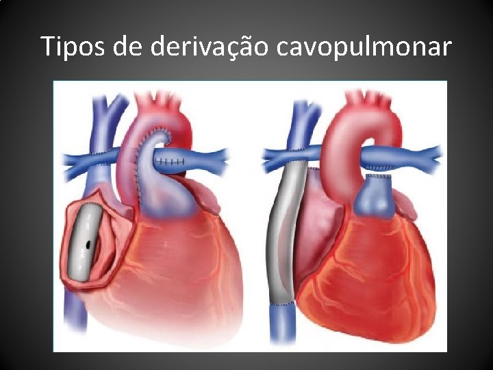 Tipos de derivação cavopulmonar 