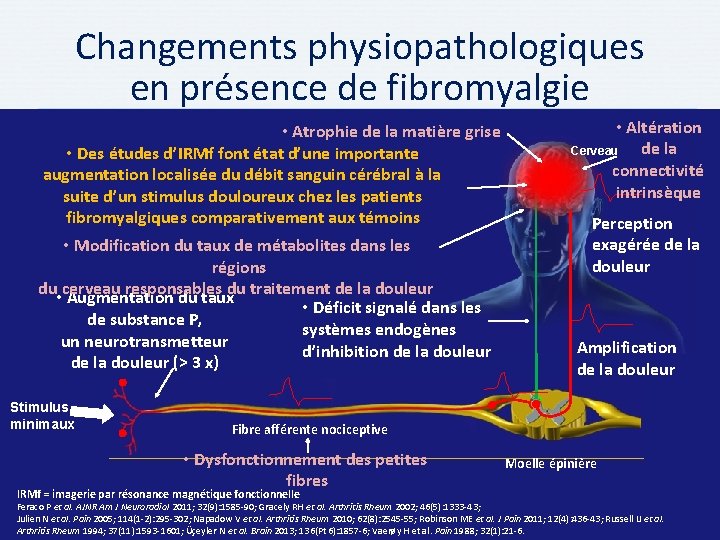 Changements physiopathologiques en présence de fibromyalgie • Atrophie de la matière grise • Des