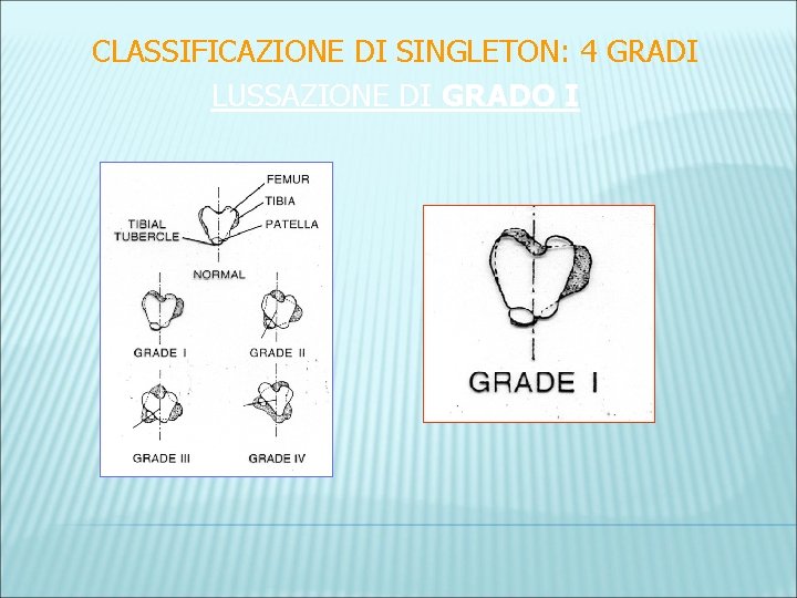 CLASSIFICAZIONE DI SINGLETON: 4 GRADI LUSSAZIONE DI GRADO I 