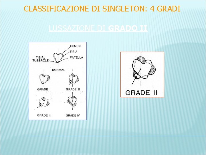 CLASSIFICAZIONE DI SINGLETON: 4 GRADI LUSSAZIONE DI GRADO II 