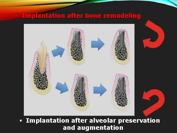 • Implantation after bone remodeling § Implantation after alveolar preservation and augmentation 