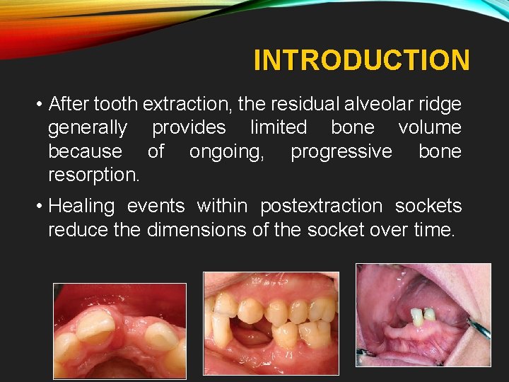 INTRODUCTION • After tooth extraction, the residual alveolar ridge generally provides limited bone volume