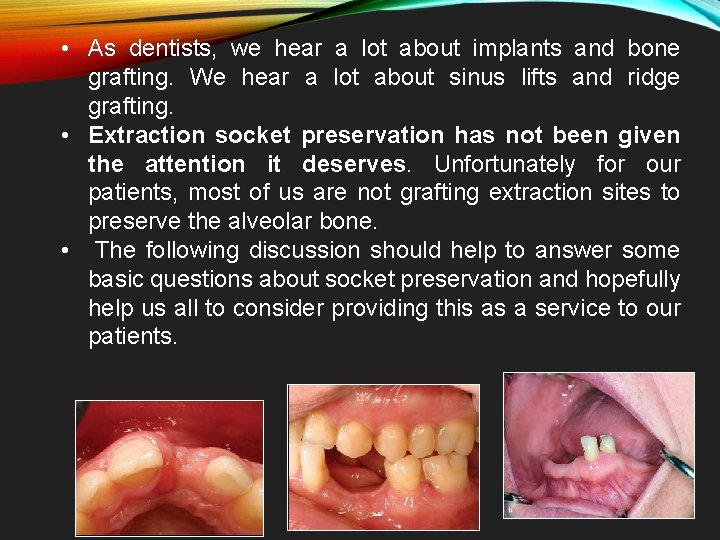  • As dentists, we hear a lot about implants and bone grafting. We