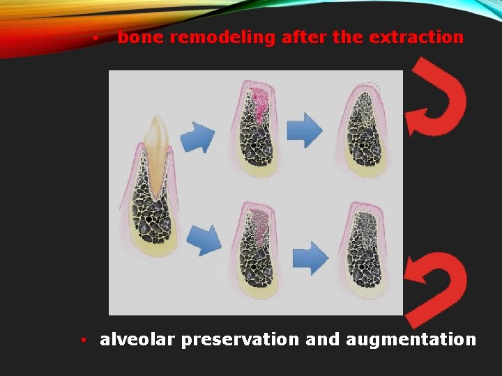 • bone remodeling after the extraction • alveolar preservation and augmentation 