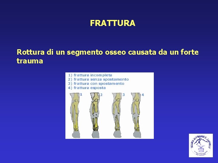 FRATTURA Rottura di un segmento osseo causata da un forte trauma 