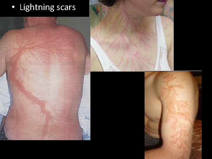 • Lightning scars • Lightning scars