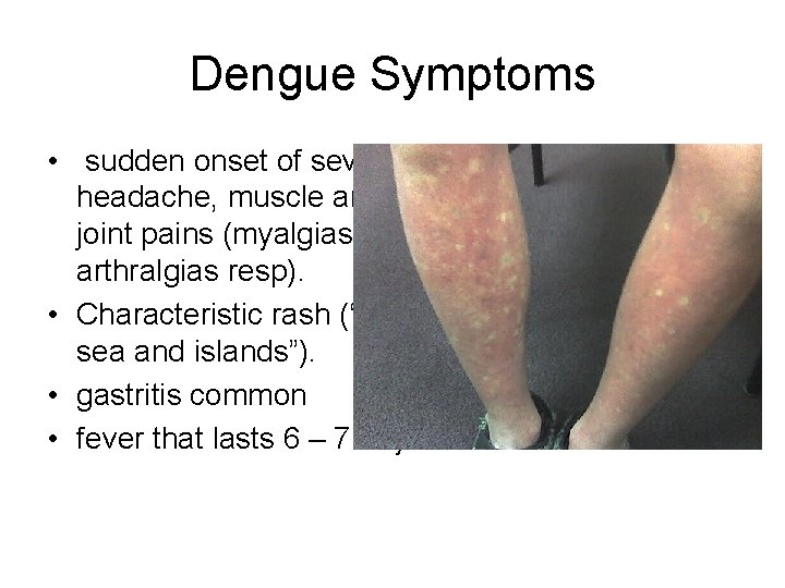 Dengue Symptoms • sudden onset of severe headache, muscle and joint pains (myalgias and Dengue Symptoms • sudden onset of severe headache, muscle and joint pains (myalgias and